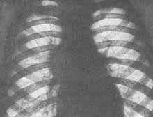 Бронхоаденит у взрослых и детей