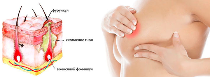 фурункул на груди