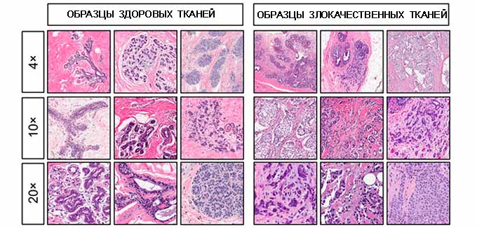 Расшифровка результатов гистологии Сравнение образцов злокачественных и доброкачественных тканей