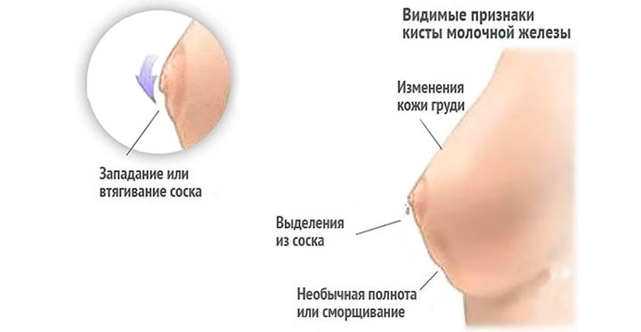 Основные симптомы симптомы рака соска