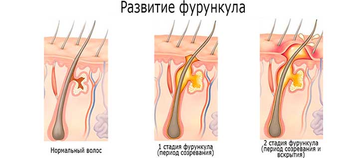 Основные характеристики фурункула развитие фурункула