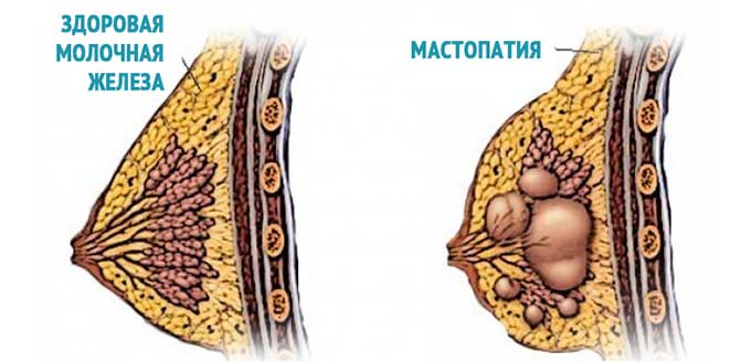 Значение витаминов в терапии мастопатии Как выглядит мастопатия