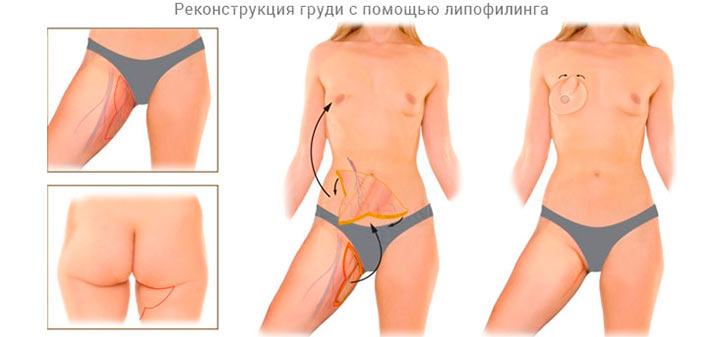 Первый этап (липосакция) реконструкция груди своим жиром