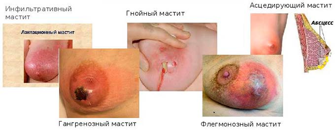 Особенности гнойного мастита и его формы Формы мастита груди