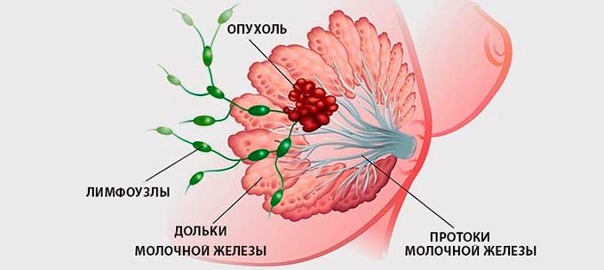 Почему ощущаются боли при раке молочных желез Опухоль в молочной железе