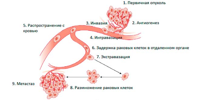 В каких клинических ситуациях рак груди вызывает метастазы Схема распространения клеток опухоли