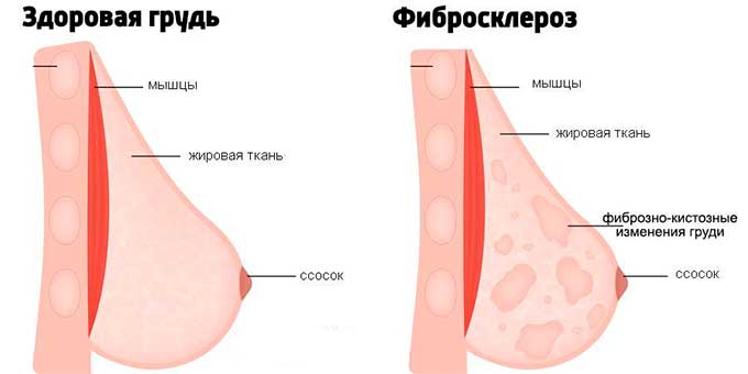 Что такое фибросклероз груди? Фибросклероз груди