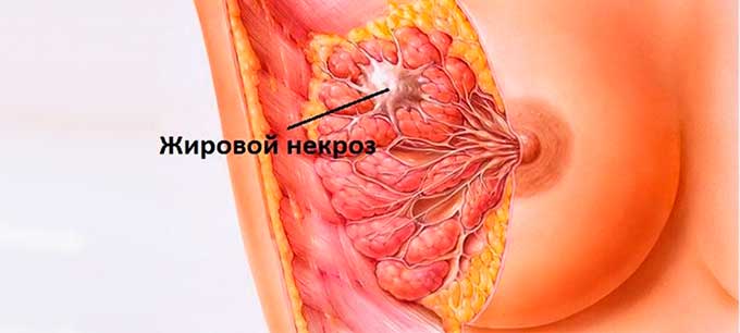 Что такое жировой некроз груди жировой некроз в молочной железе