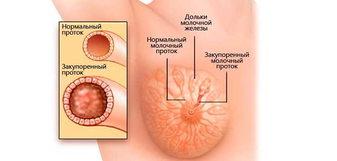 Что такое эктазия молочной железы? расширенные протоки в молочных железах