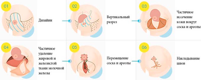 Последовательность операции техника вертикальной подтяжки груди