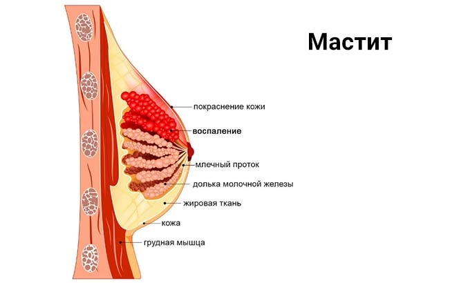Мастит (грудница) Мастит (грудница)