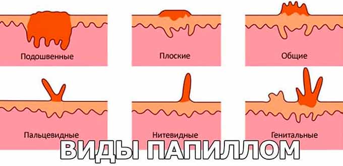 виды папиллом