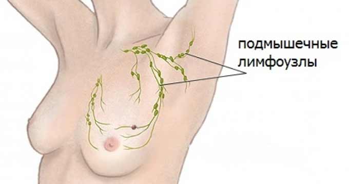 Что такое аксиллярные лимфатические узлы Подмышечные лимфоузлы