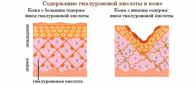 Особенности применения гиалуроновой кислоты для коррекции бюста свойства гиалуроновой кислоты