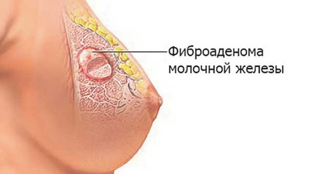 Причины появления болезненности Фиброаденома молочной железы