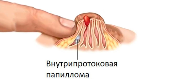 внутрипротоковая папиллома груди