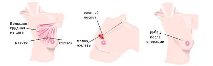 Что такое лампэктомия молочных желез? лампэктомия