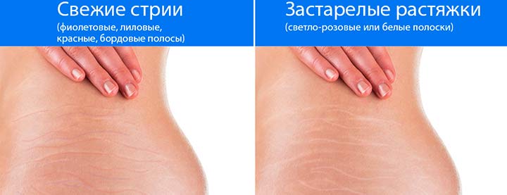 Что такое растяжки и как они выглядят? растяжки на груди