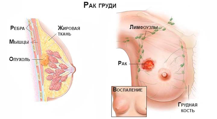 рак груди