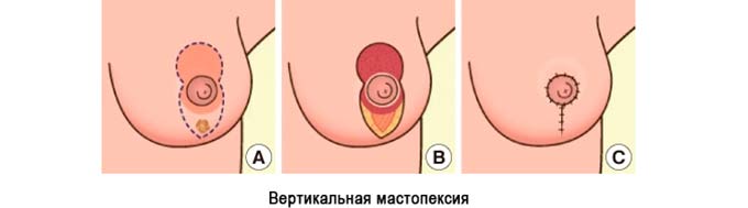 вертикальная подтяжка кожи груди