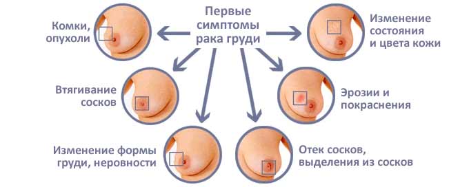 Особенности проявления симптомов при онкологии Симптомы онкологии груди