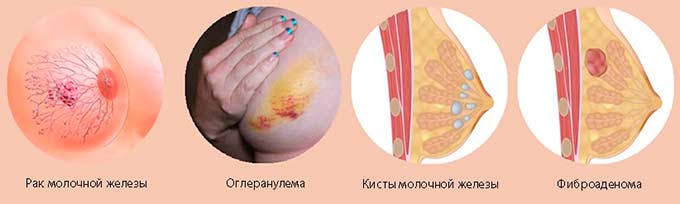 Виды и формы состояния Виды образований в груди