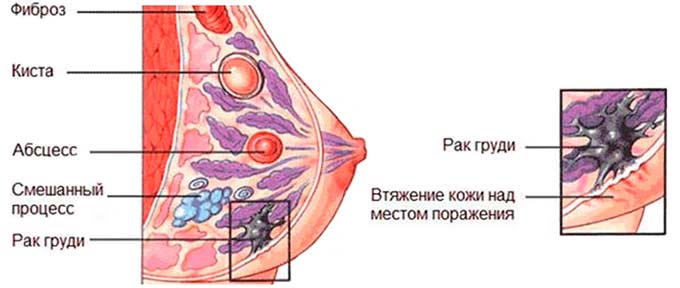 Показания к проведению Образования в молочных железах