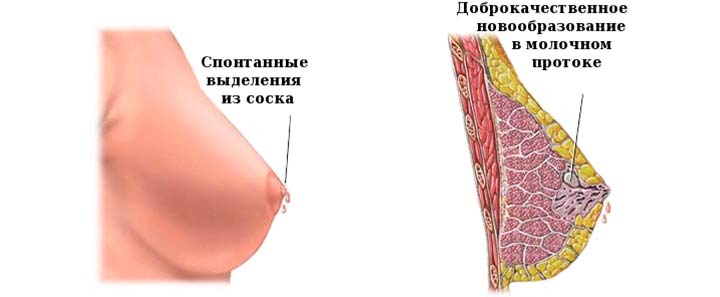 Симптомы внутрипротоковой папилломы симптомы папиллом в груди