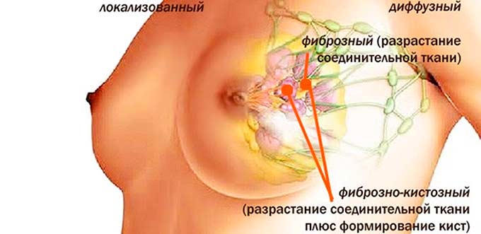 Формы опухоли Формы аденоза груди