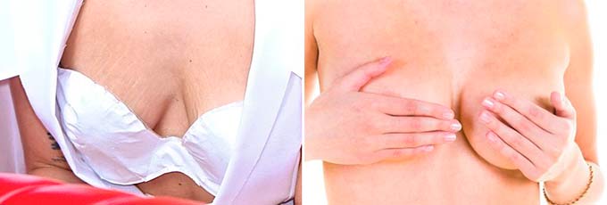 Показания к выполнению процедуры обвисшая и асимметричная грудь