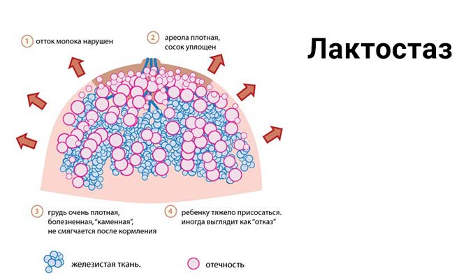 Лактостаз Лактостаз