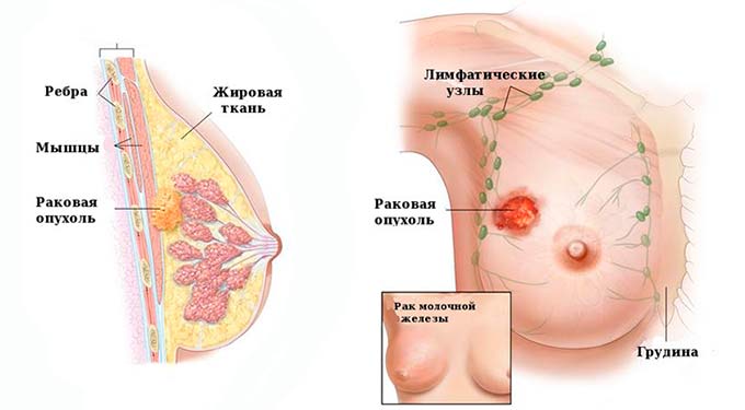 Как быстро происходит перерождение рака из второй в третью стадию Рак молочной железы