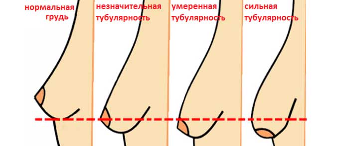 степени тубулярности груди степени тубулярности груди