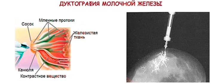 Что такое дуктография? дуктография