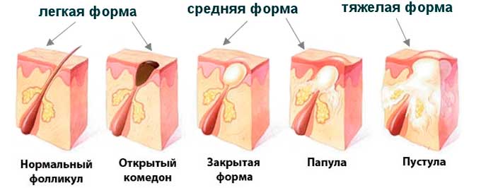 Особенности патологического состояния при беременности и лактации Разновидности прыщей