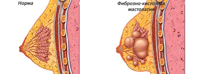 При каких состояниях можно применять фитопатчи? Мастопатия в молочной железе