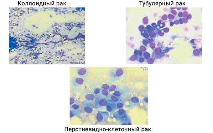 Типы слизистых форм рака