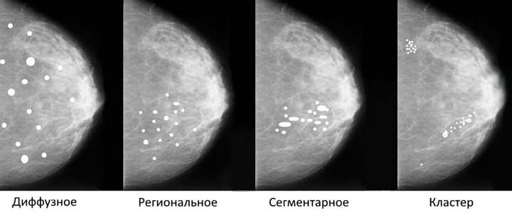 Формы микрокальцинатов в молочной железе< виды кальцинатов