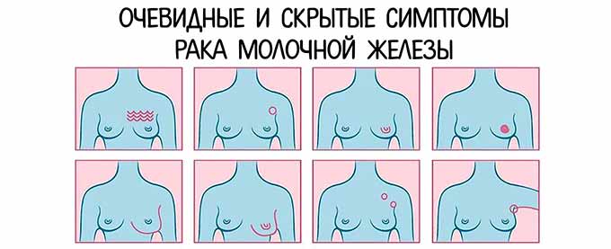Симптоматика трижды негативного рака Очевидные и скрытые симптомы РМЖ