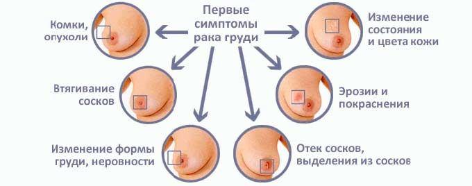 Характер симптоматики рака груди 2 стадии Характерные симптомы для рака груди