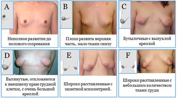 Виды и формы микромастии формы микромастии