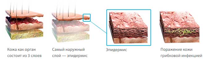Причины возникновения грибковой болезни поражение кожи грибком