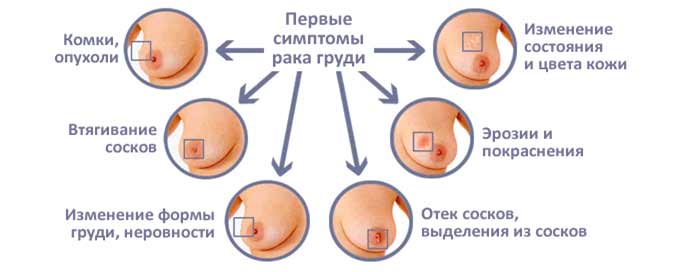 Симптомы болезненного состояния Первые симптомы рака молочных желез