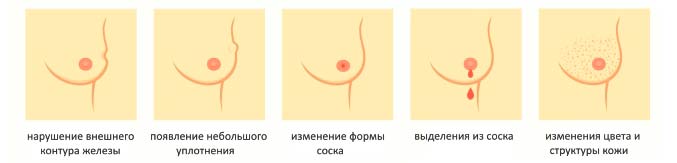 Дополнительные симптомы Симптомы маммологических заболеваний