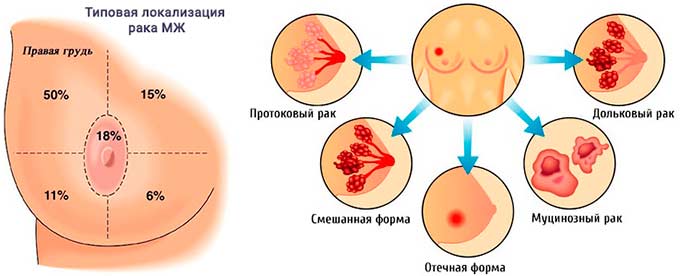 При различных формах рака груди Формы рака груди