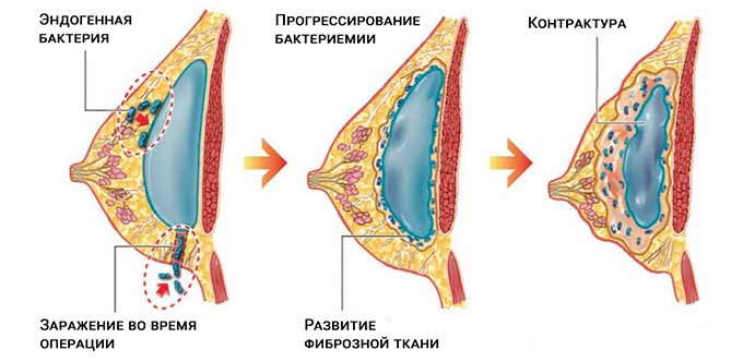 Стадии и степени развития капсулярной контрактуры развитие капсулярной контрактуры от импланта