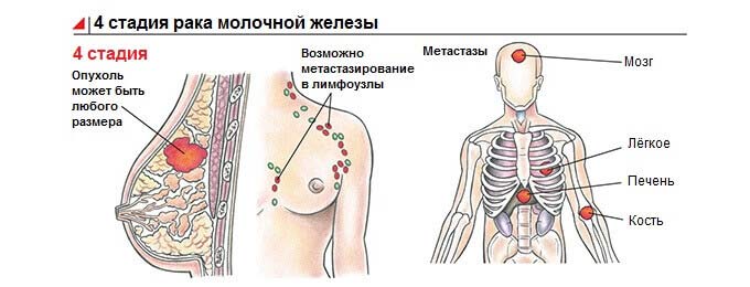 Рак груди 4 стадии