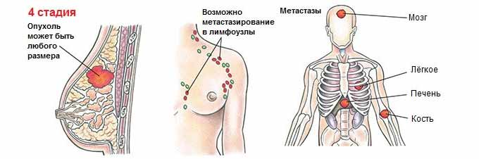 Какими последствиями опасно патологическое состояние Метастазы и заражение лимфоузлов раковыми клетками