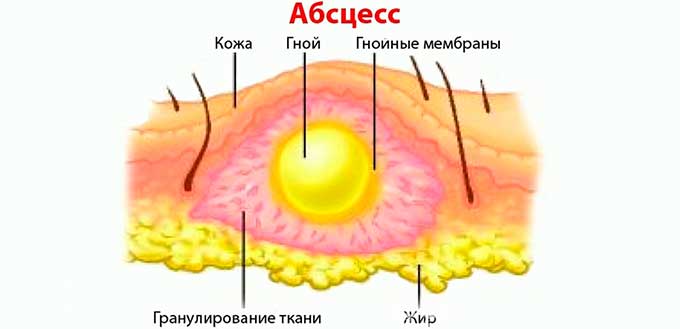Может ли ушиб спровоцировать осложнения Гнойный абсцес