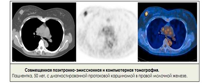 Расшифровка диагностических результатов Результаты КТ груди